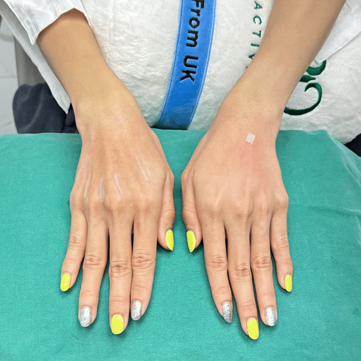 ฉีดฟิลเลอร์มือ อุดร