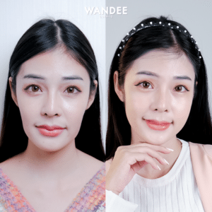 ฟิลเลอร์ใต้ตา