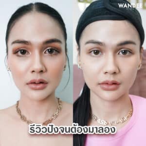 ฟิลเลอร์ใต้ตา