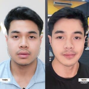 รีวิวโบท็อกซ์