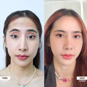 รีวิวโบท็อกซ์