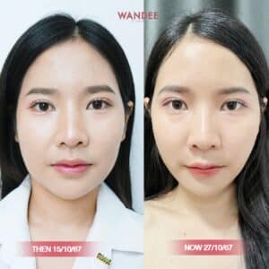 รีวิวโบท็อกซ์