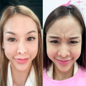 รีวิวโบท็อกซ์