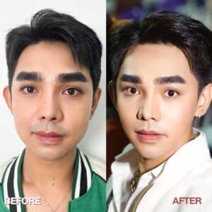 รีวิวโบท็อกซ์