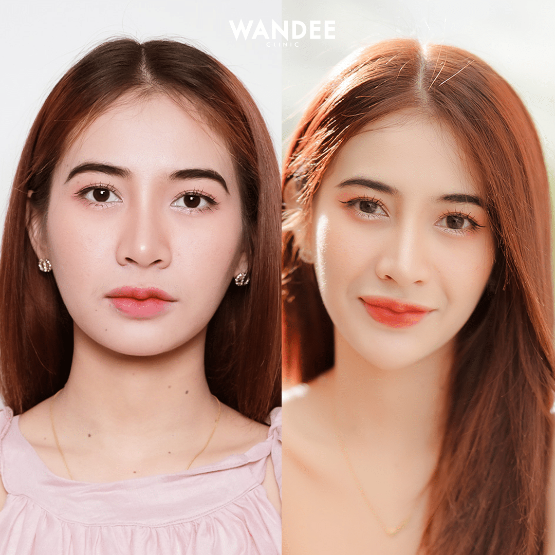 รีวิวฟิลเลอร์