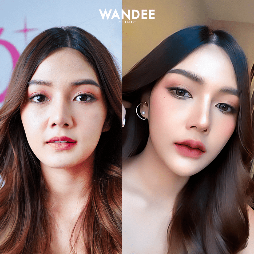 รีวิวฟิลเลอร์