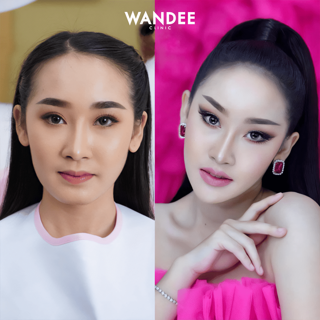 รีวิวฟิลเลอร์