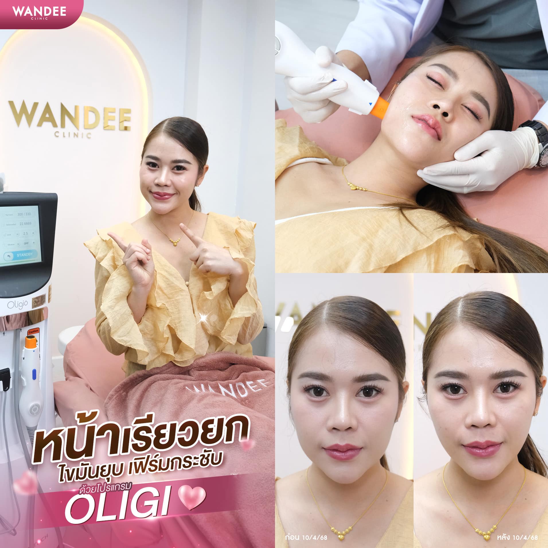 oligio หน้าเรียว