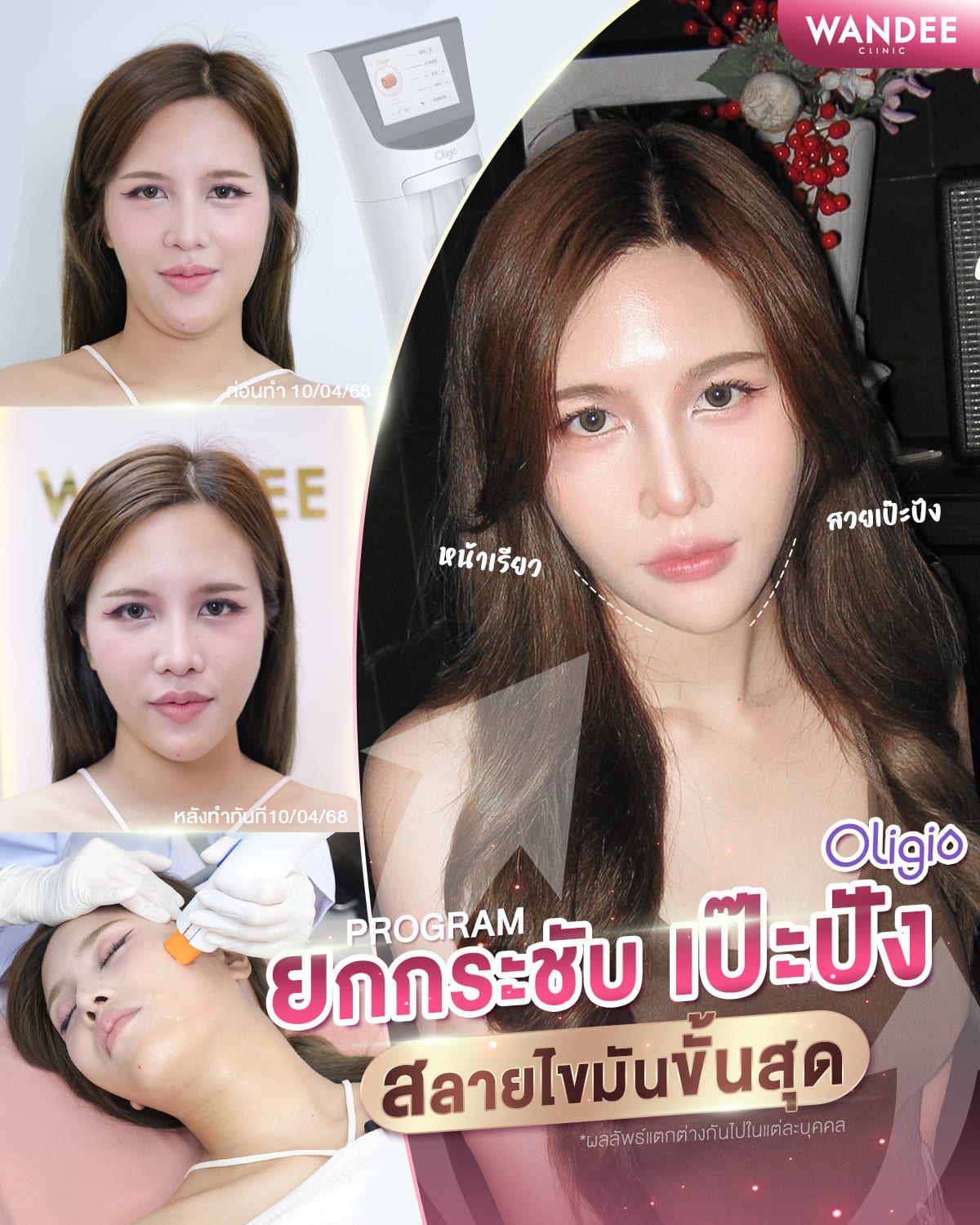 ยกกระชับหน้า