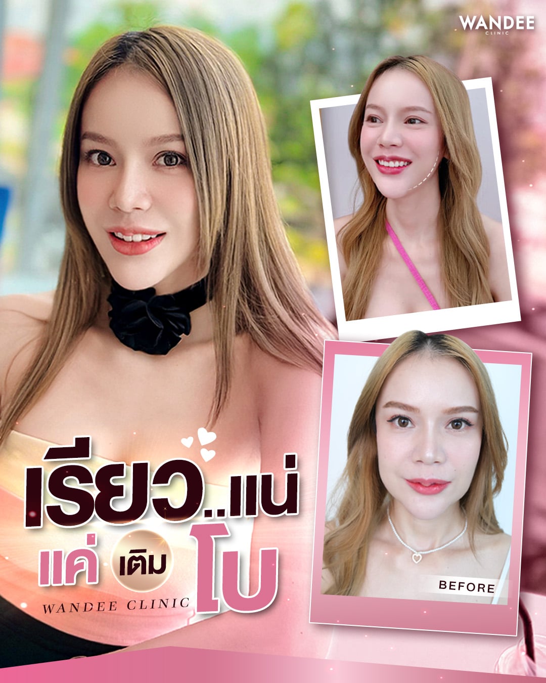 รีวิวโบท็อกซ์