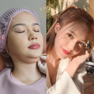 รีวิวเมโสแฟต