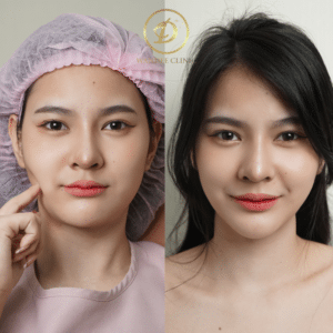 รีวิวเมโสแฟต