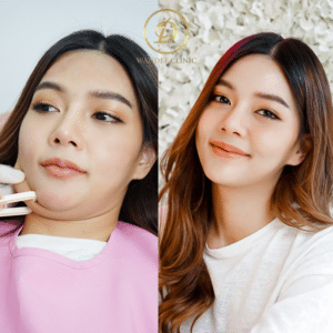 รีวิวเมโสแฟต