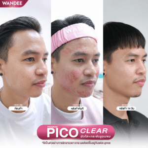 รีวิว pico laser