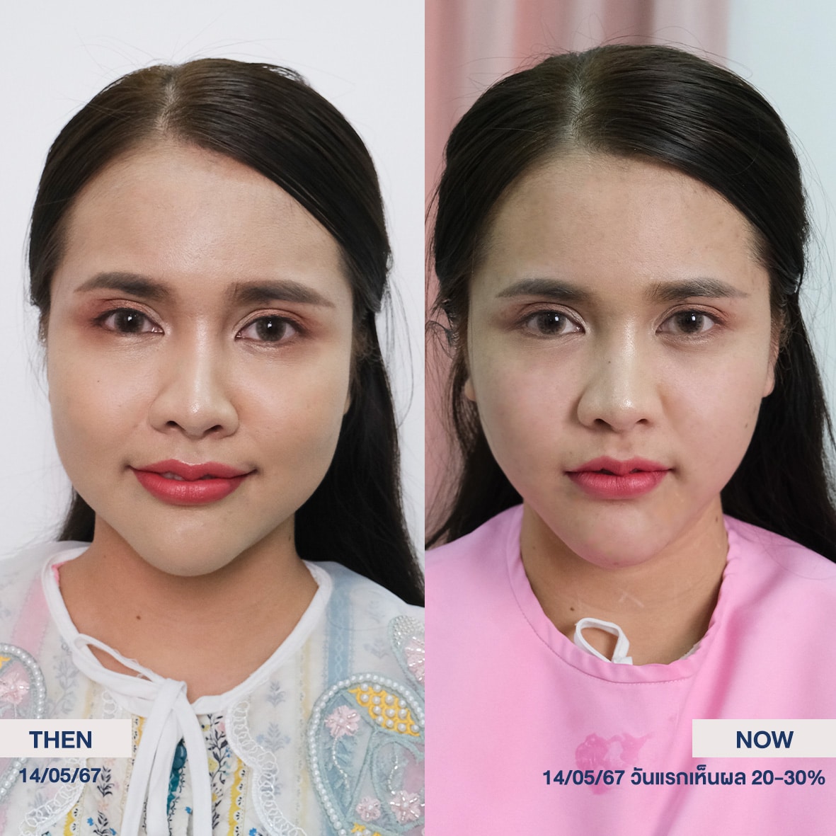 รีวิว ultraformer