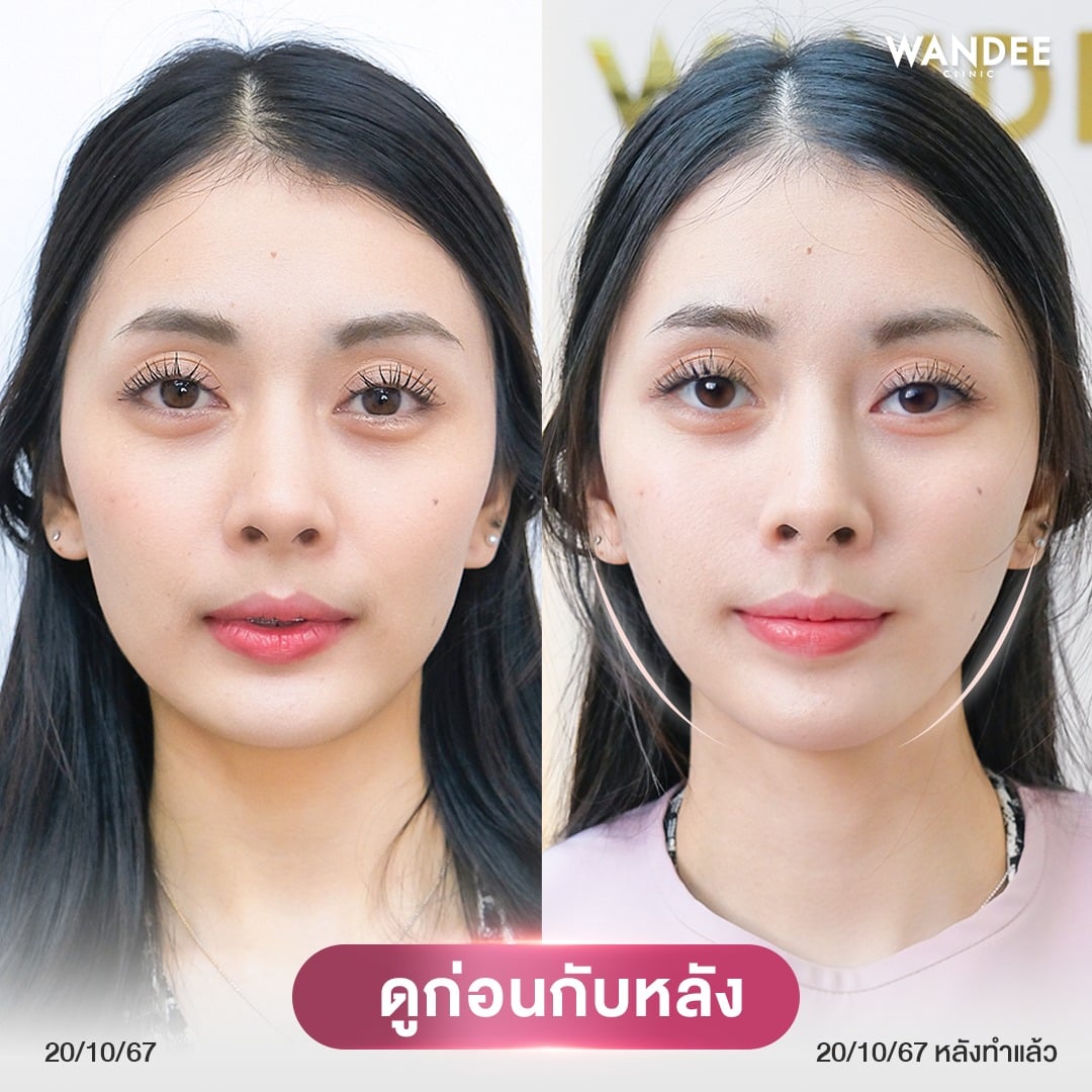 รีวิว ultraformer