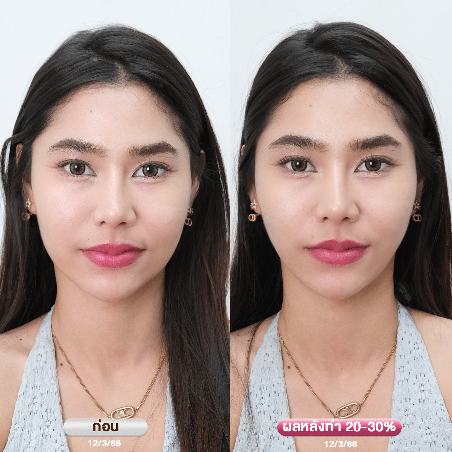 รีวิว ultraformer