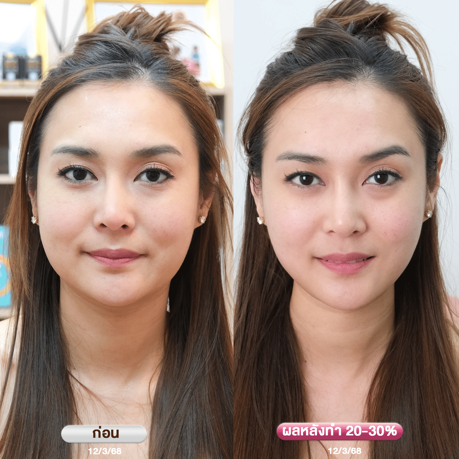 รีวิว ultraformer