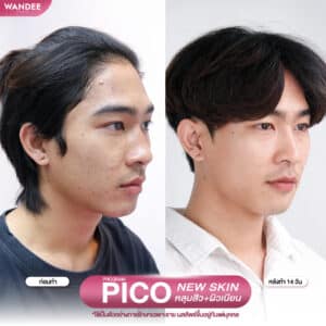 รีวิว pico laser