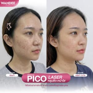 รีวิว pico laser