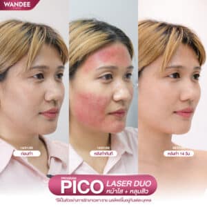 รีวิว pico laser