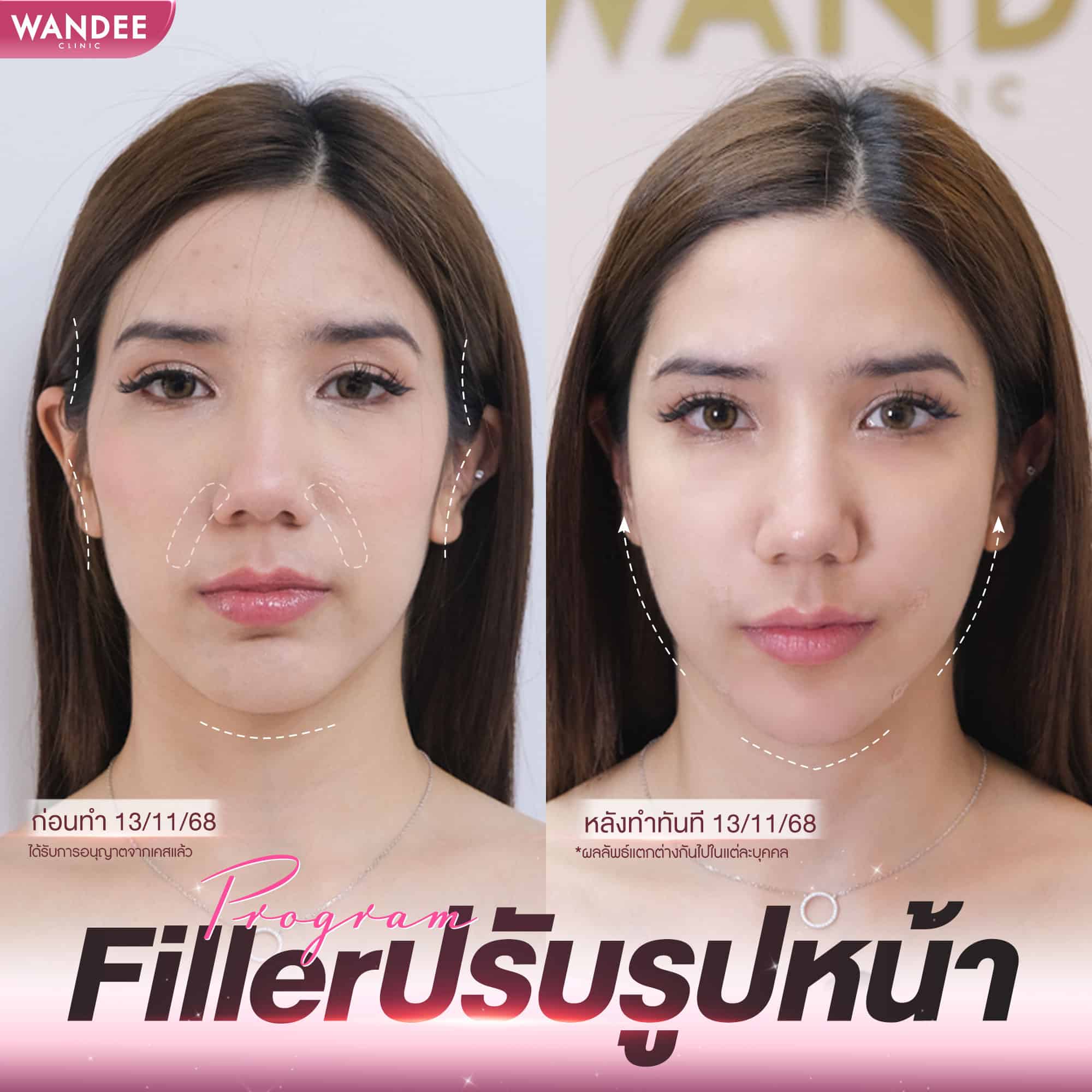 รีวิวฟิลเลอร์