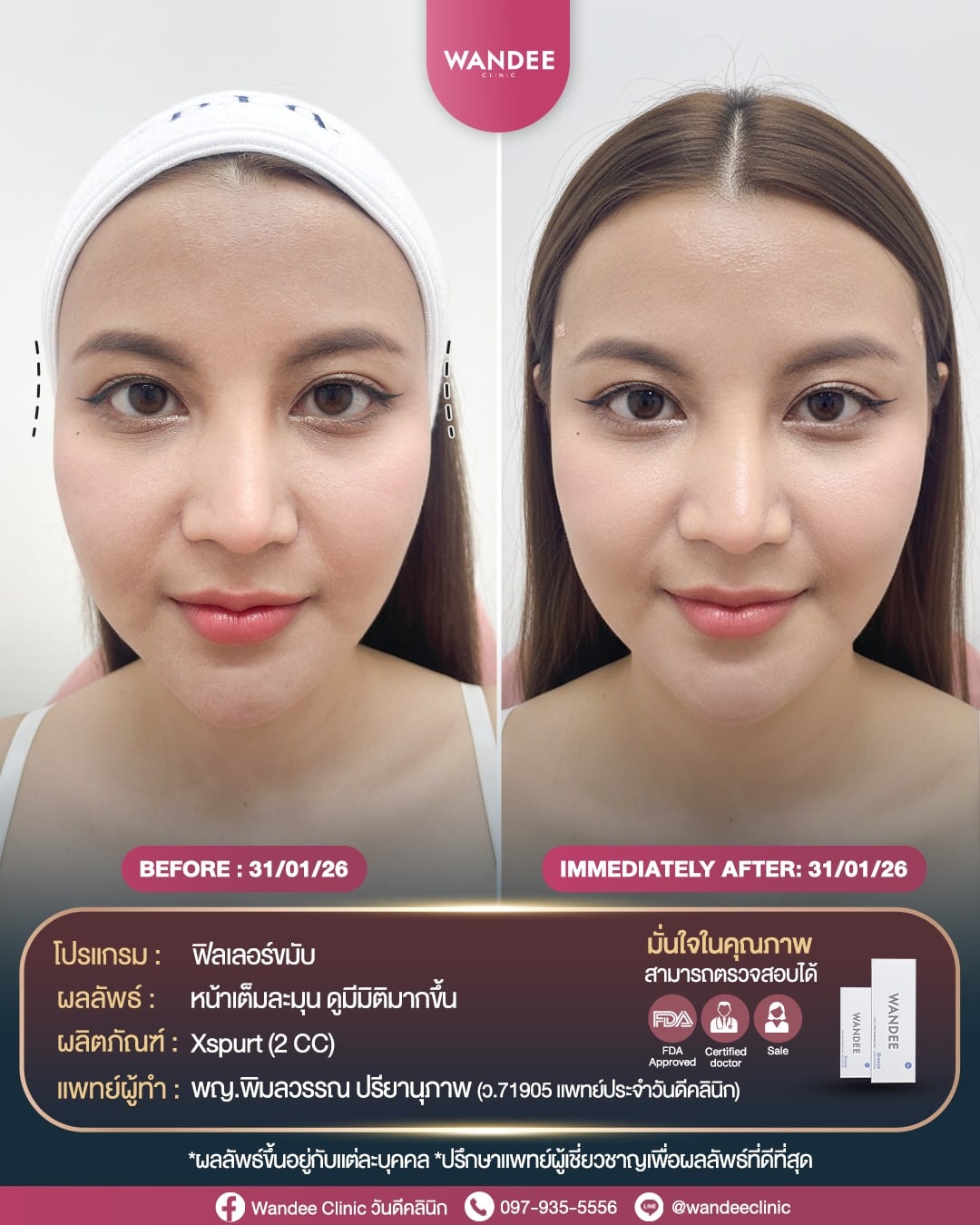 รีวิว Xspurt Filler