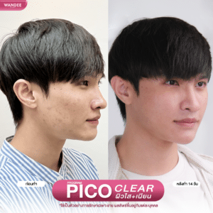 รีวิว pico laser